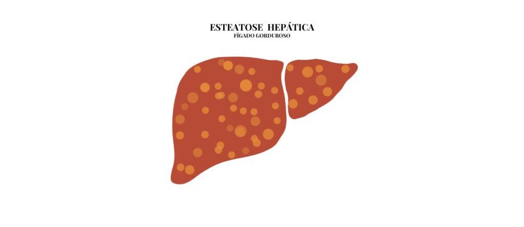 Esteatose Hepática: Acúmulo de Gordura no Fígado